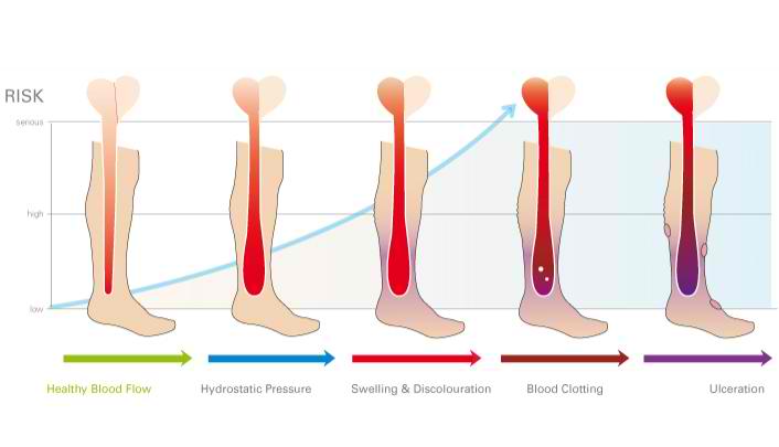 Leg Ulcers - The Circulation Foundation