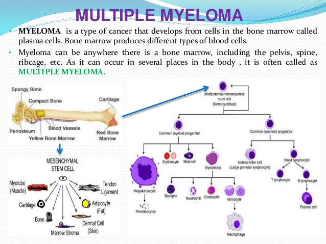 What is multiple myeloma?