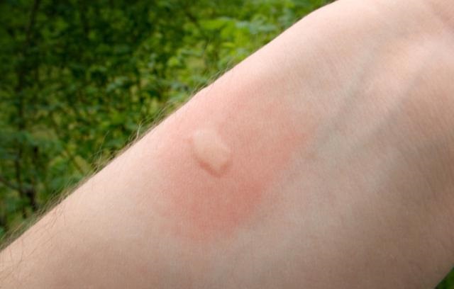 RÃ©sultat de recherche d'images pour "Mosquito bites"