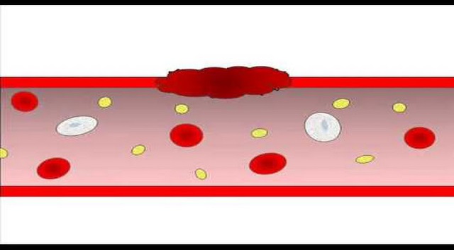 Understanding Platelets and Blood Clotting