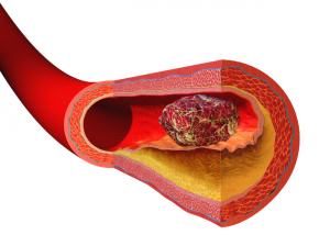 Blood Clot Symptoms