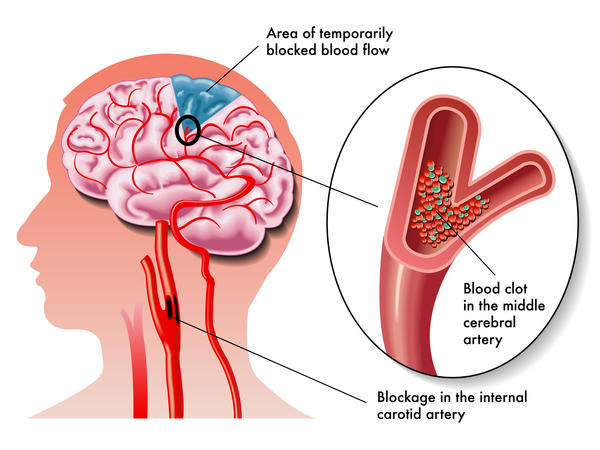 blood clots travel to brain