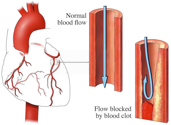 Blood clot in heart