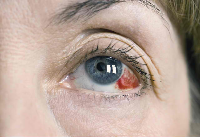 blood clot in eye