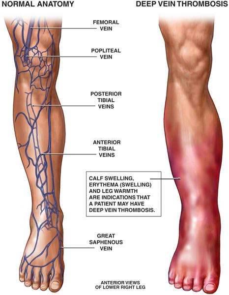 dvt deep vein thrombosis symptoms