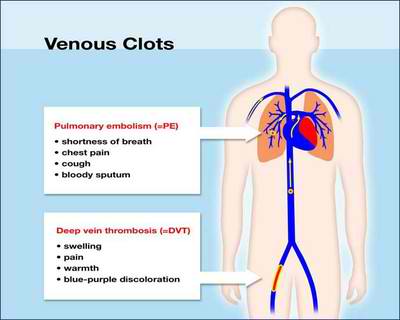 dvt deep vein thrombosis pe