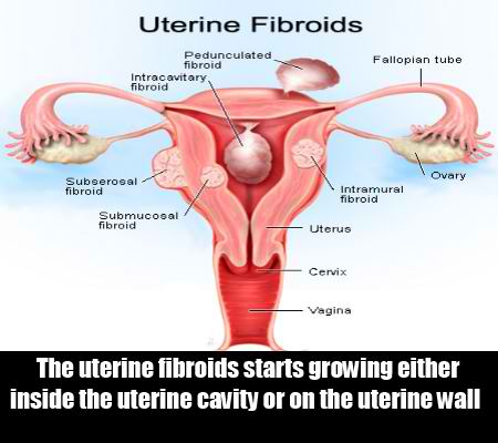 menstrual period blood clots uterine fibroids