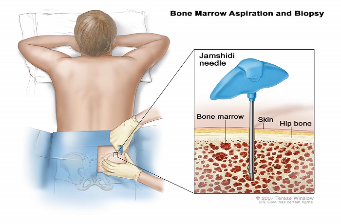 bone marrow biopsy procedure