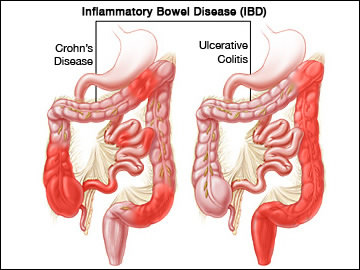 causes of blood in stool pooping blood inflammatory bowel disease
