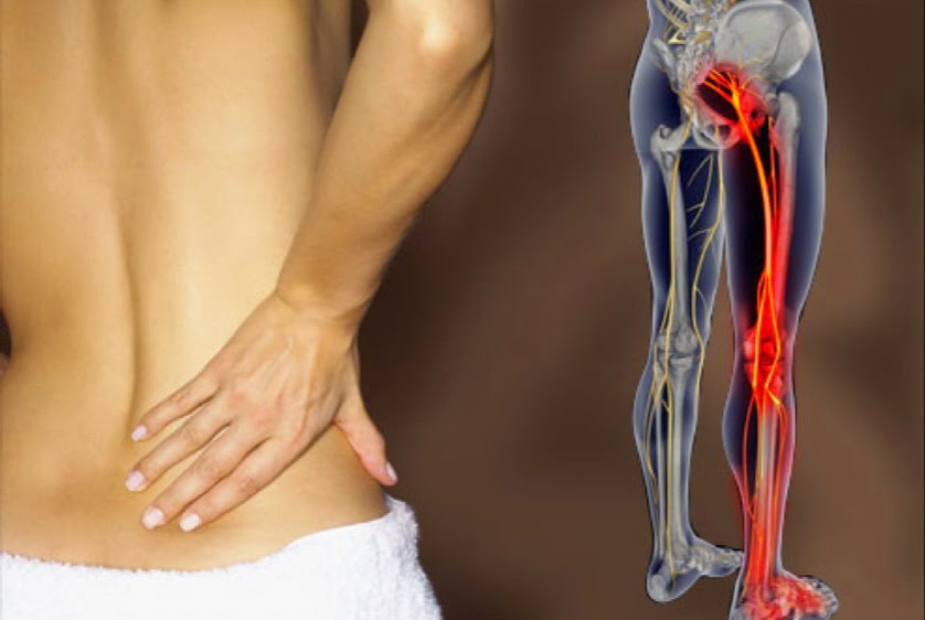 sciatica pain relief treatment remedies and exercises