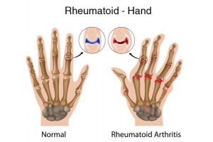Rheumatoid-Arthritis-treatment