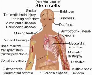 Stem Cell Transplant Procedure