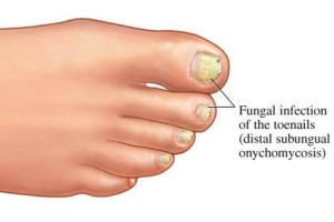 best toenail fungus treatment