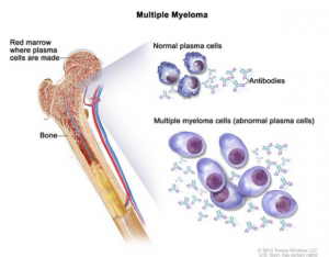 multiple myeloma life expectancy
