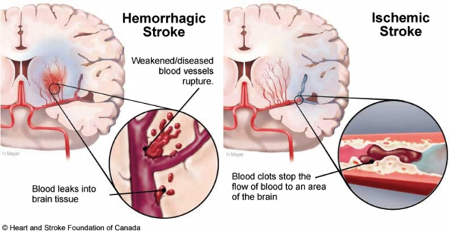 stroke treatment