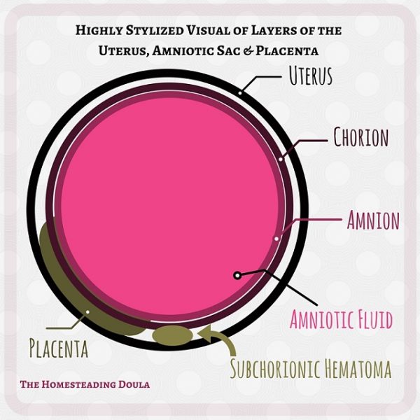 10 Facts About Subchorionic Hematoma