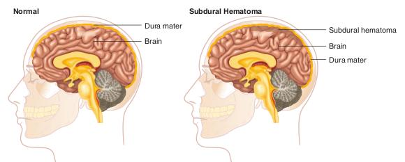 subdural hematoma