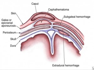 subgaleal hematoma