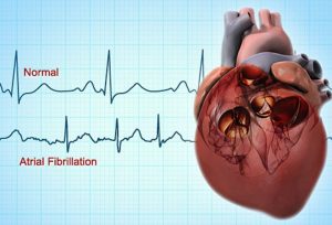 Best Food Diet Practices for Atrial Fibrillation